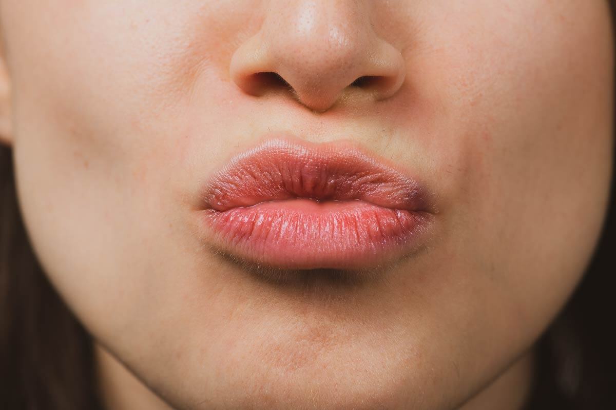 嘴唇腫起來怎麼消?8大嘴唇消種方法，讓嘴唇回到健康飽滿狀態!