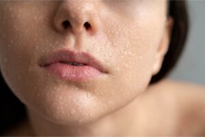鼻頭粉刺清除5妙招，讓你擁有潔淨透亮的肌膚！
