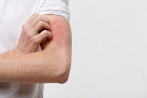 止漏性皮膚炎解析：8個關鍵問題及有效根治方法！