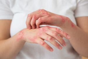 手指長水泡：小病兆或身體大警訊？解析、處理方法與預防措施！